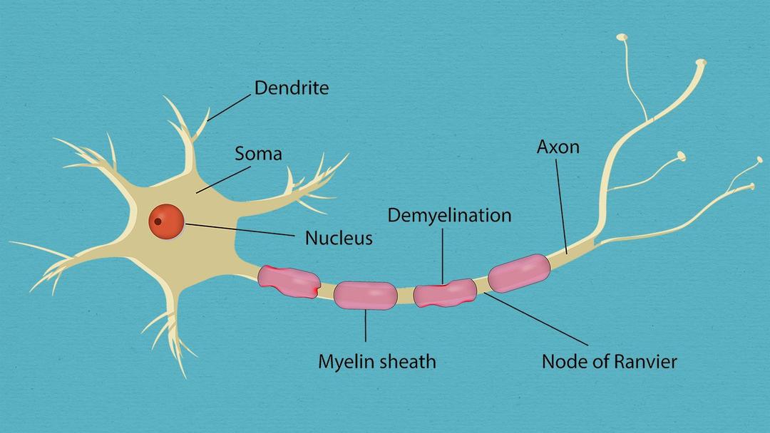 What Is Guillain-Barré Syndrome? Symptoms, Causes, Diagnosis, Treatment, and Prevention